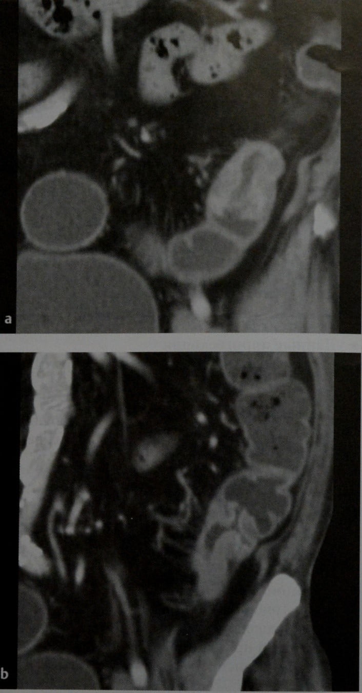 Снимки МРТ и КТ. Рак ободочной кишки