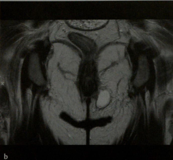 Снимки МРТ и КТ. Перианальные свищи и абсцессы