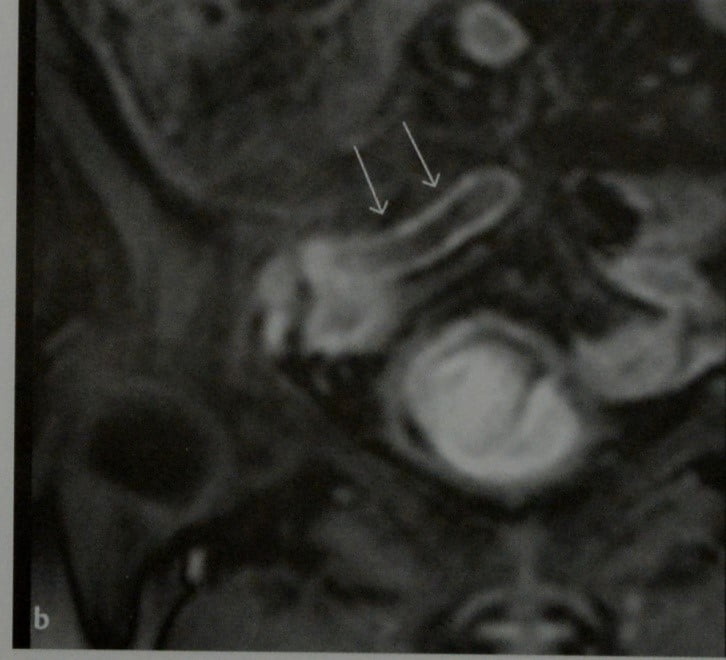 Снимки МРТ и КТ. Острый аппендицит