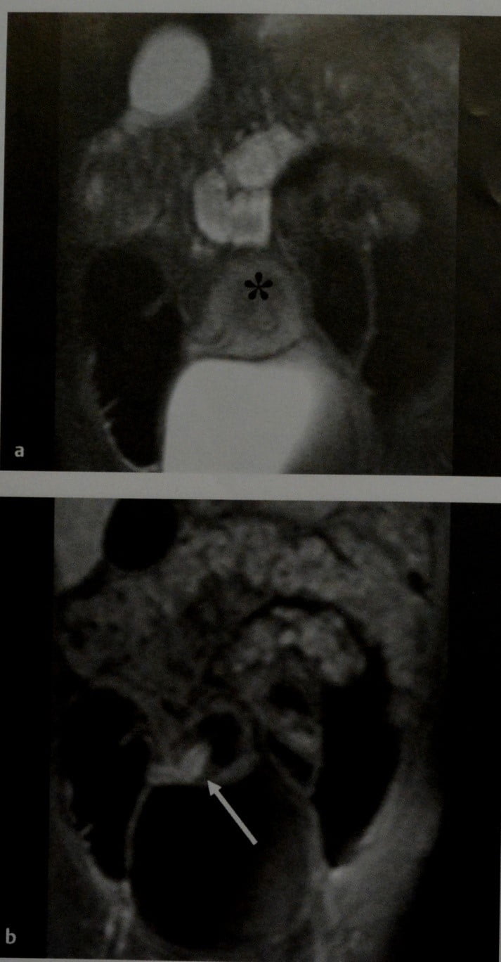 Снимки МРТ и КТ. Острый аппендицит