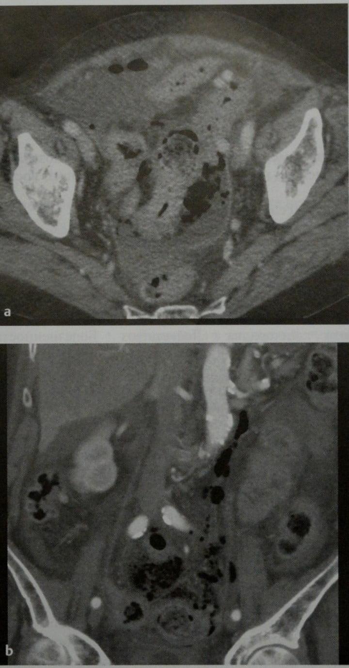 Снимки МРТ и КТ. Дивертикулит толстого кишечника