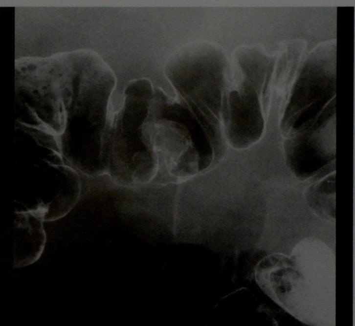 Снимки МРТ и КТ. Аденоматозные полипы толстого кишечника
