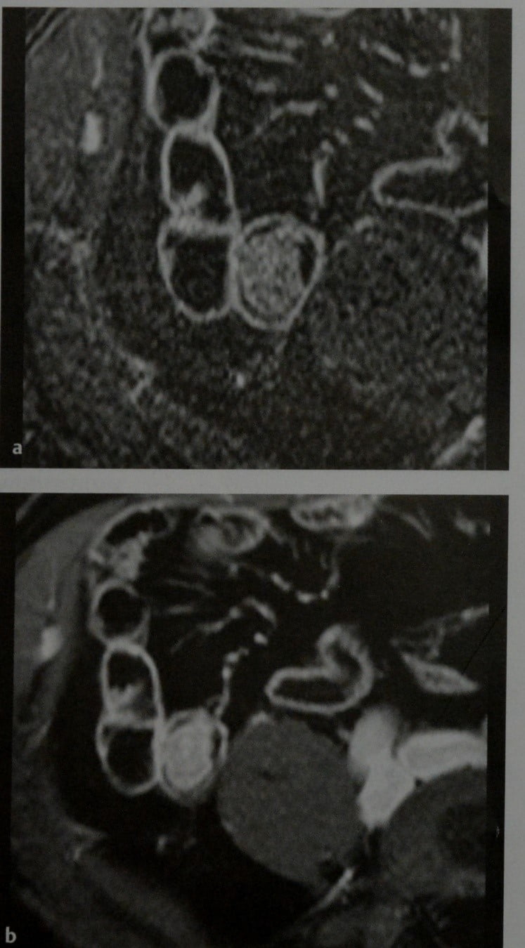 Снимки МРТ и КТ. Аденоматозные полипы толстого кишечника