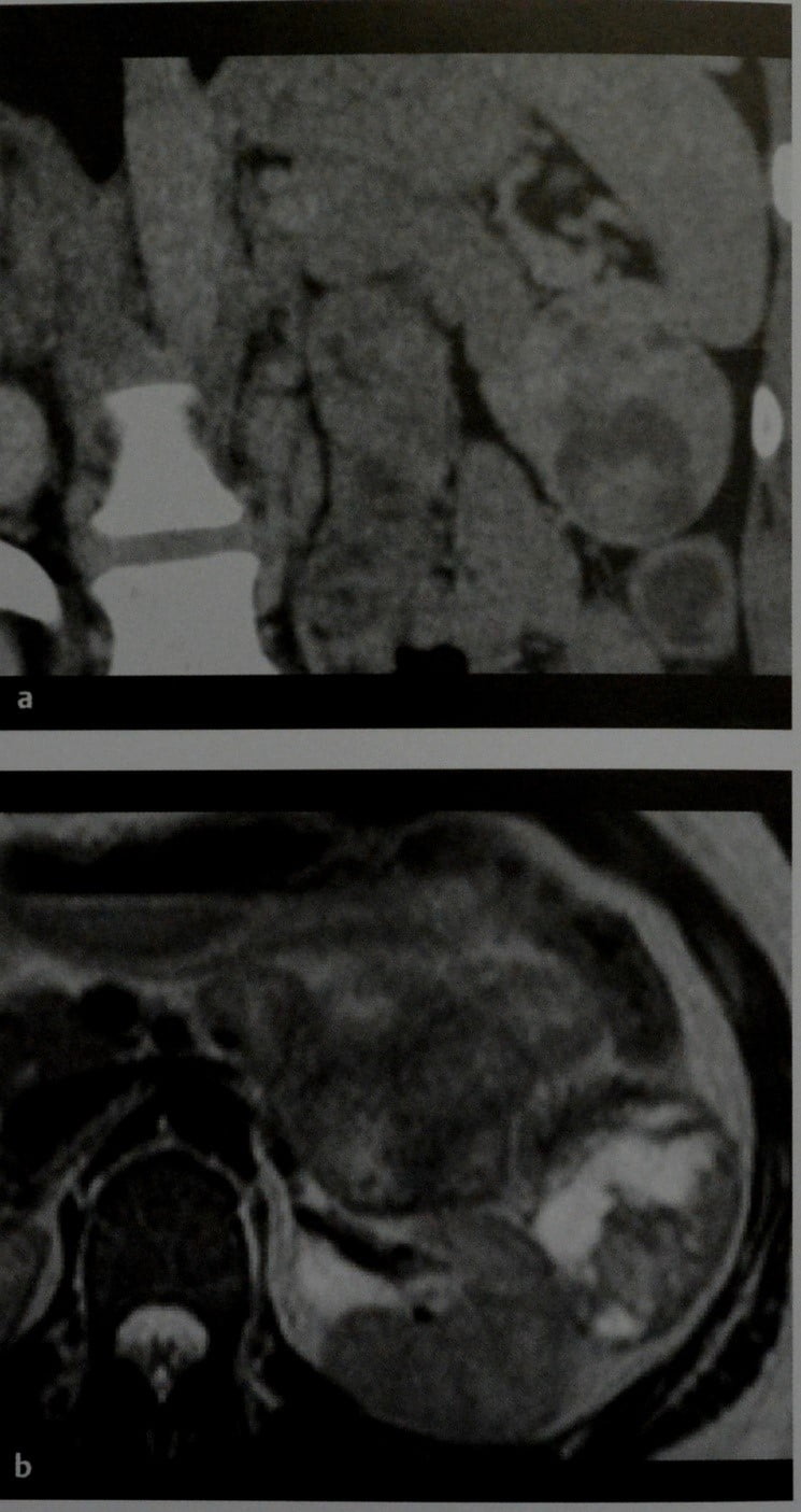 Снимки МРТ и КТ. Солидная псевдопапиллярная опухоль