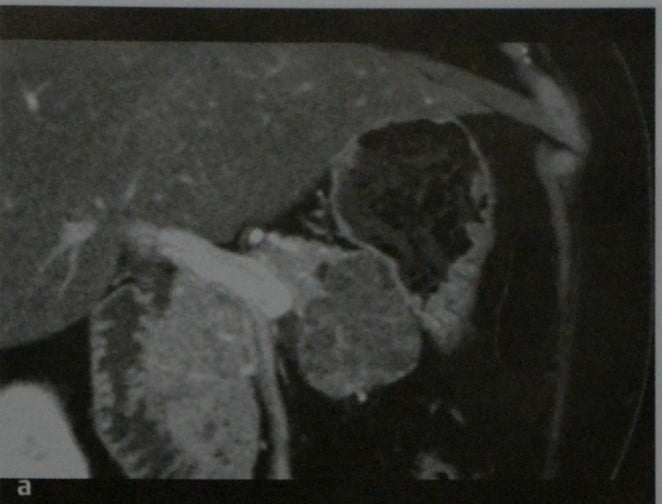 Снимки МРТ и КТ. Серозная цистаденома