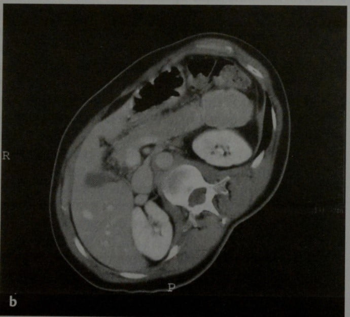 Снимки МРТ и КТ. Нефункционирующие эндокринные опухоли