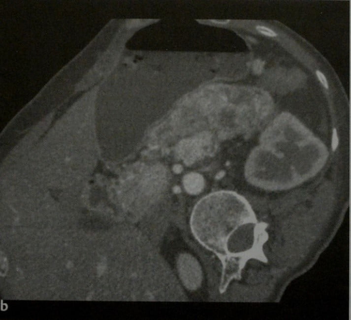 Снимки МРТ и КТ. Нефункционирующие эндокринные опухоли