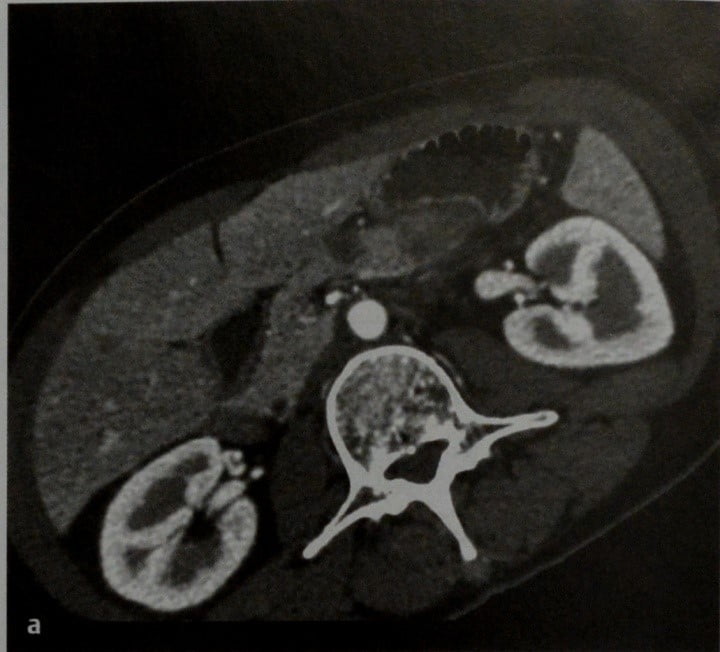 Снимки МРТ и КТ. Метастатическое поражение поджелудочной железы