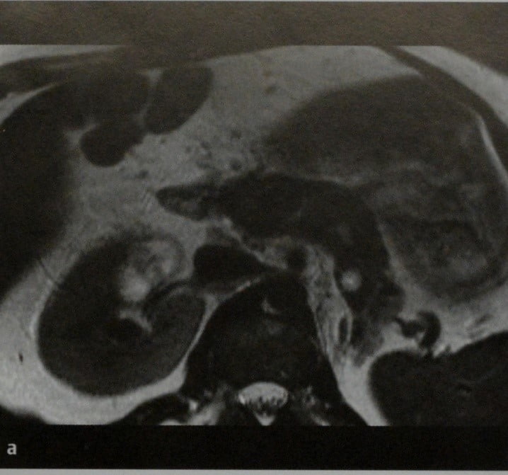Снимки МРТ и КТ. Метастатическое поражение поджелудочной железы