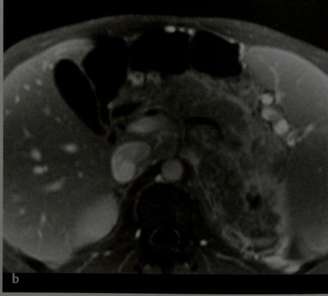 Снимки МРТ и КТ. Лимфома поджелудочной железы