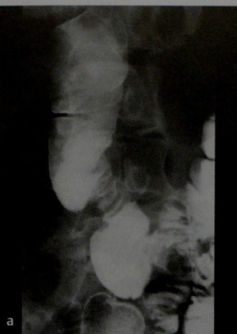 Снимки МРТ и КТ. Кольцевидная поджелудочная железа