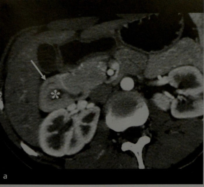 Снимки МРТ и КТ. Кольцевидная поджелудочная железа