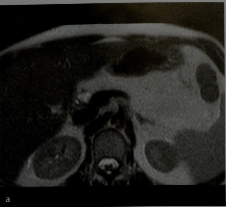 Снимки МРТ и КТ. Кистозный фиброз