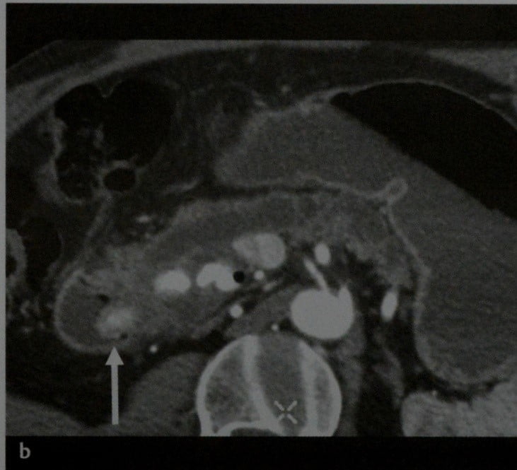 Снимки МРТ и КТ. Внутрипротоковая сосочковая слизистая опухоль