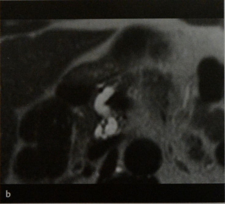 Снимки МРТ и КТ. Внутрипротоковая сосочковая слизистая опухоль