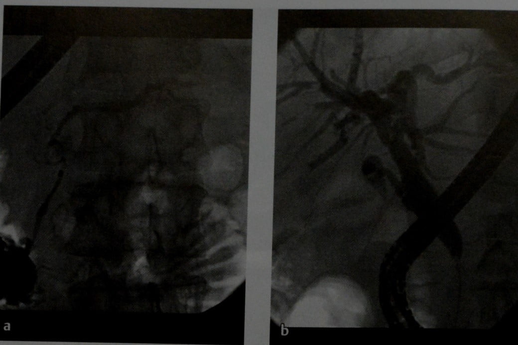 Снимки МРТ и КТ. Аутоиммунный панкреатит