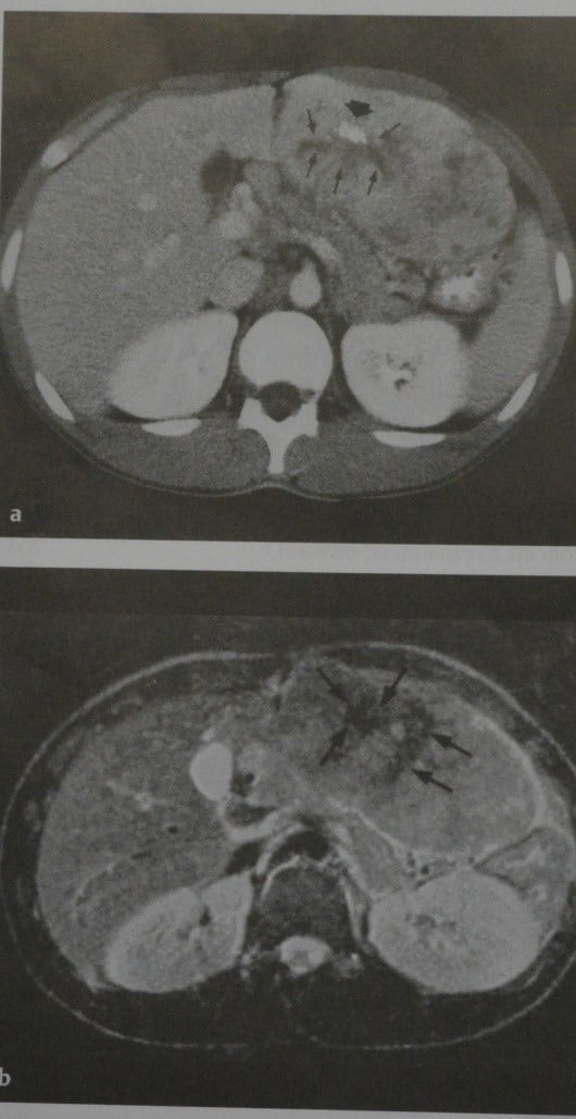 Снимки МРТ и КТ. Фиброламеллярная гепатоцеллюлярная карцинома