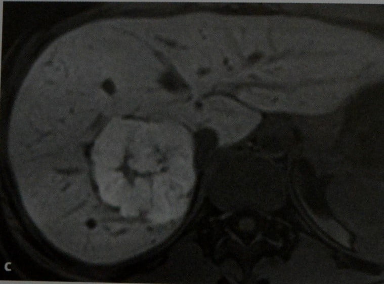 Снимки МРТ и КТ. Очаговая узловая гиперплазия