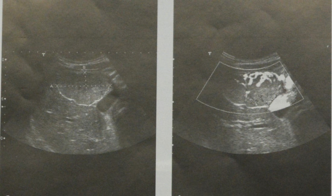 Снимки МРТ и КТ. Очаговая узловая гиперплазия