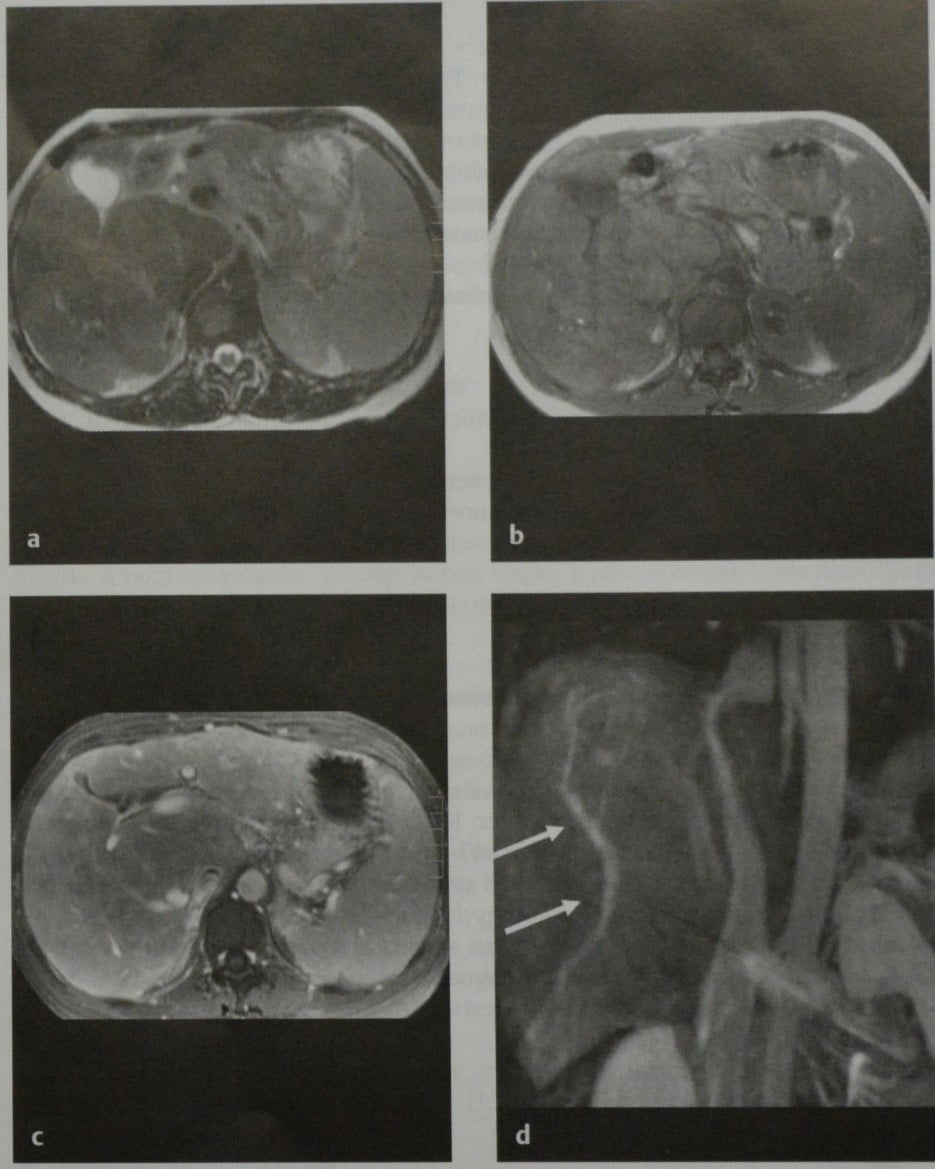 Снимки МРТ и КТ. Синдром Бадда-Киари