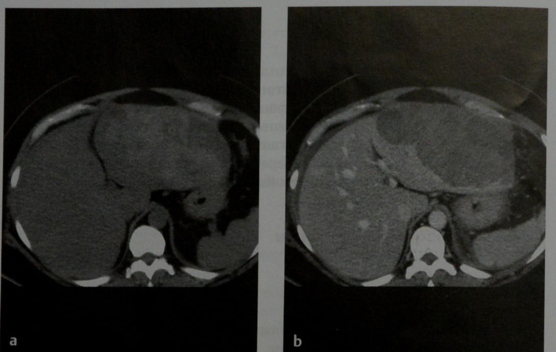 Снимки МРТ и КТ. Острое печеночное кровотечение
