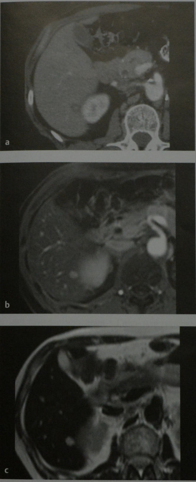 Снимки МРТ и КТ. Метастазы в печень