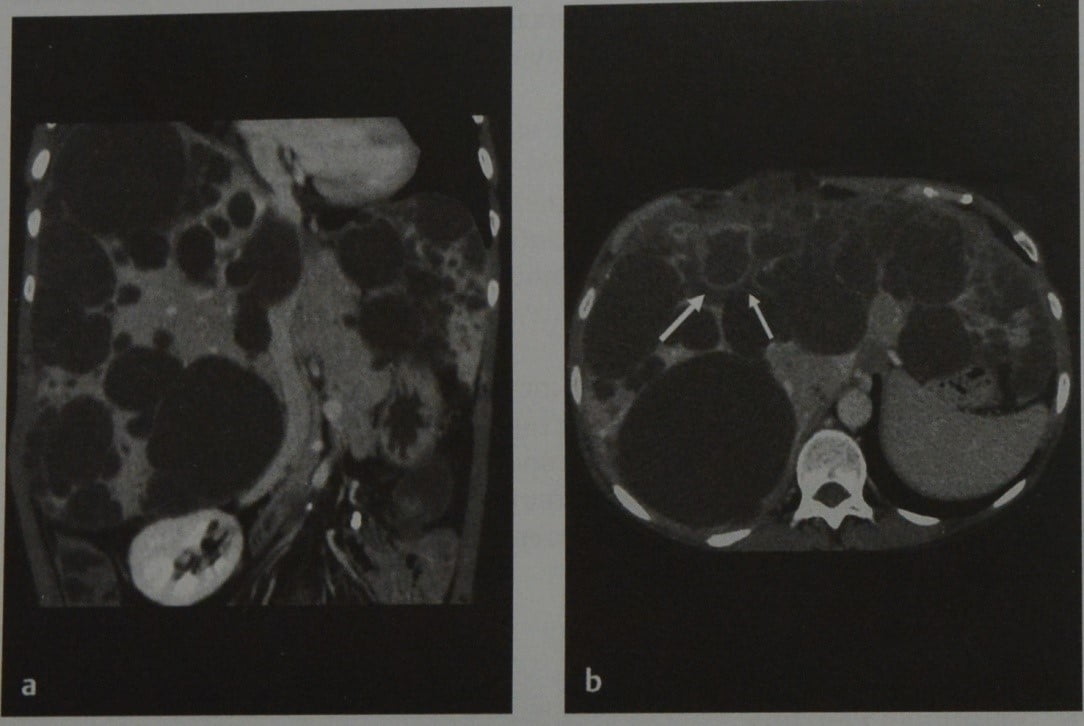 Снимки МРТ и КТ. Кисты печени