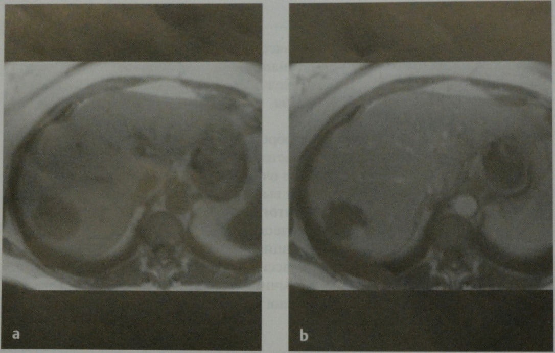 Снимки МРТ и КТ. Кавернозная гемангиома