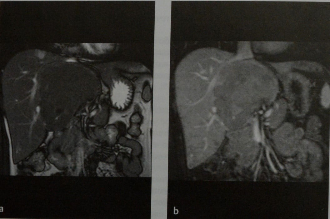 Снимки МРТ и КТ. Гепатоцеллюлярная аденома