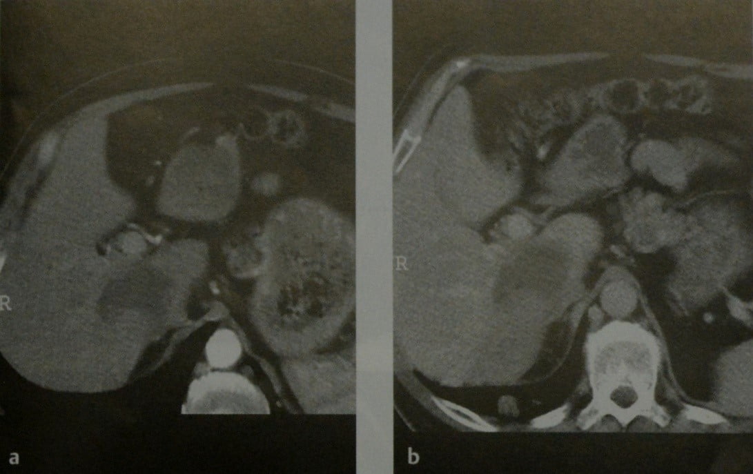 Снимки МРТ и КТ. Альвеолярный эхинококкоз