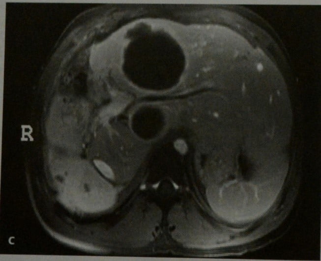 Снимки МРТ и КТ. Альвеолярный эхинококкоз