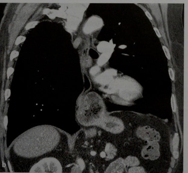 Снимки МРТ и КТ. Грыжа пищеводного отверстия диафрагмы