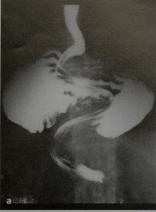 Снимки МРТ и КТ. Грыжа пищеводного отверстия диафрагмы