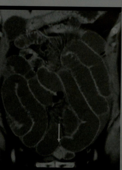 Снимки МРТ и КТ. Острая обструкция тонкого кишечника