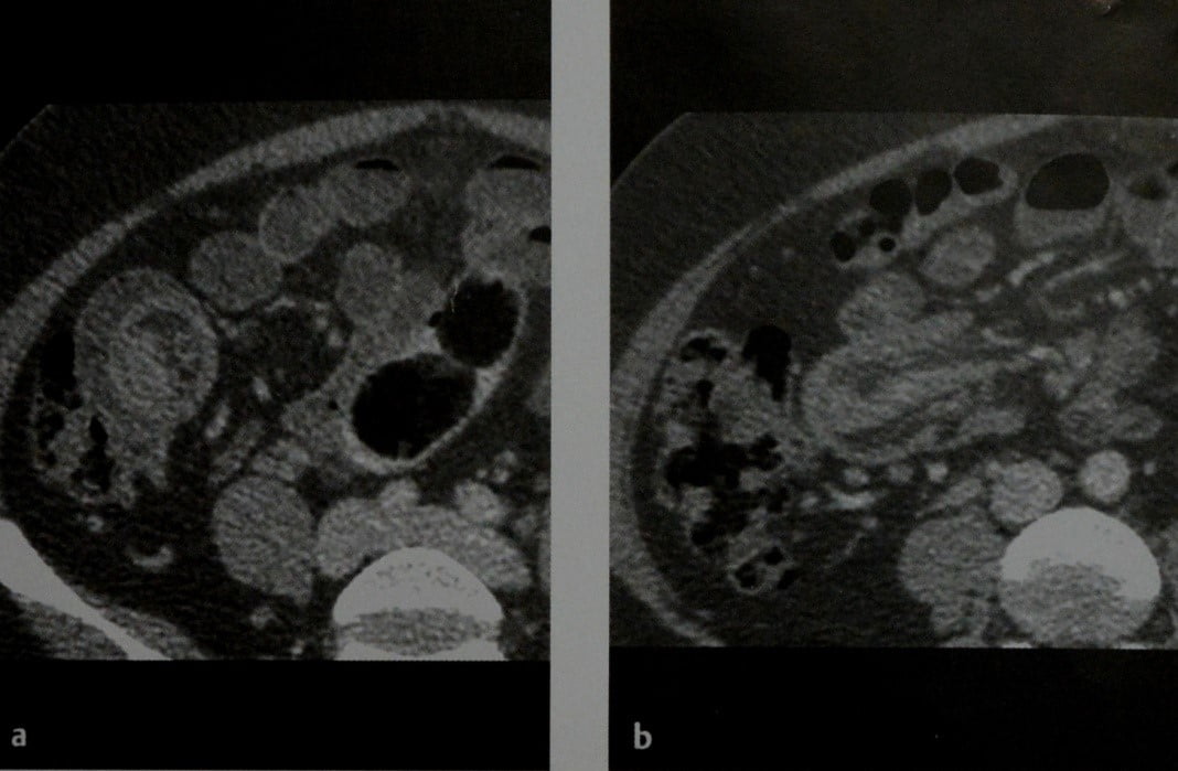 Снимки МРТ и КТ. Острая обструкция тонкого кишечника