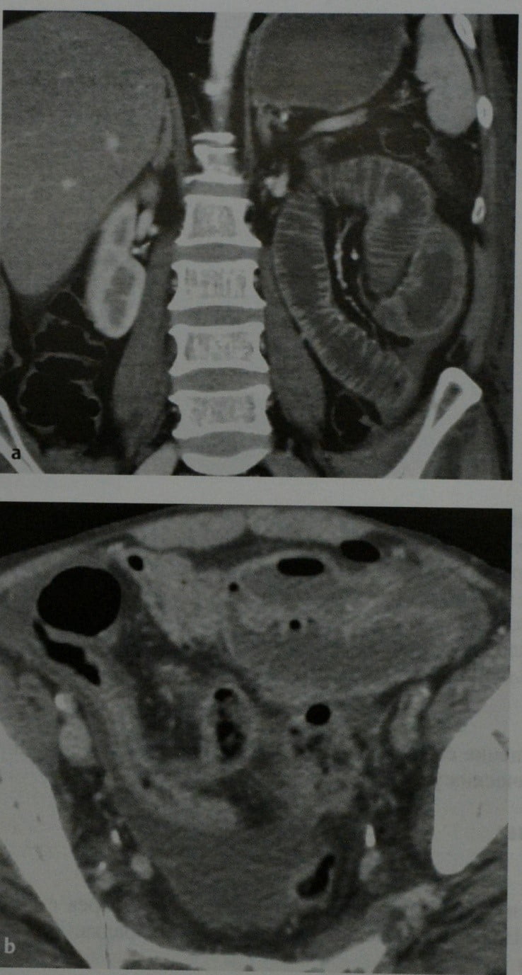 Снимки МРТ и КТ. Лимфома тонкого кишечника