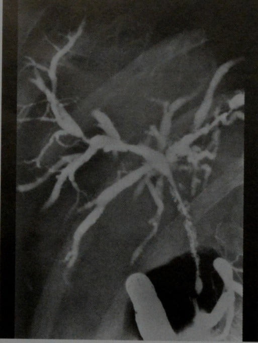 Снимки МРТ и КТ. Первичный склерозирующий холангит