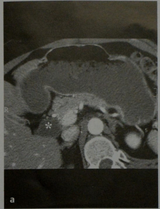 Снимки МРТ и КТ. Киста общего желчного протока