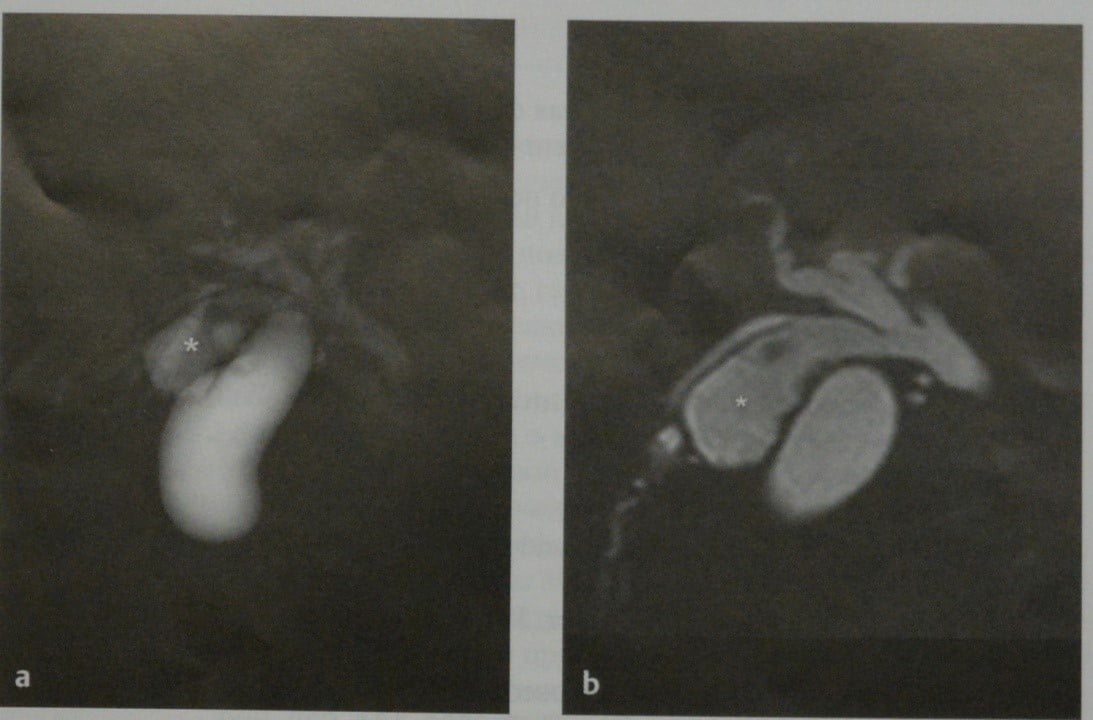 Снимки МРТ и КТ. Добавочный желчный пузырь