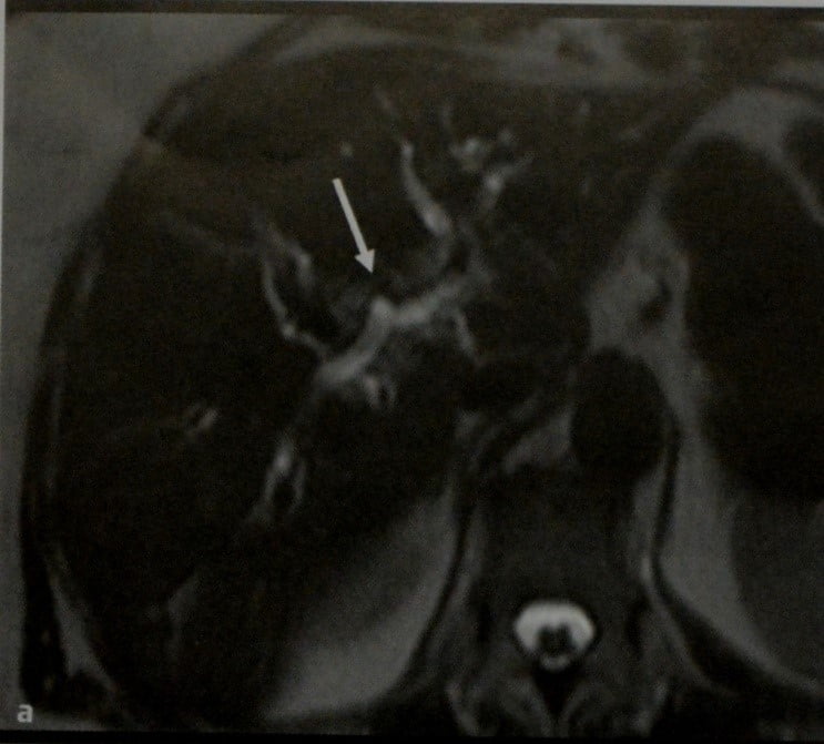 Снимки МРТ и КТ. Внепеченочная карцинома желчного протока