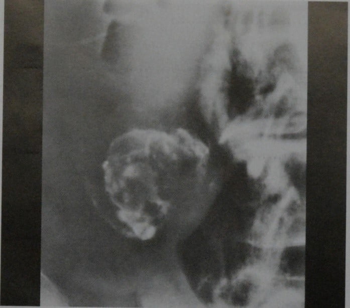 Снимки МРТ и КТ. Аденома желчного пузыря