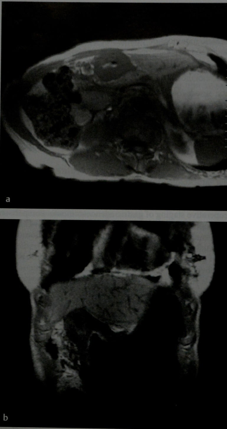 Снимки МРТ и КТ. Рак желудка