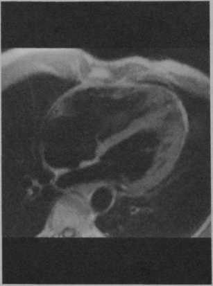 Снимки МРТ и КТ. Хроническая легочная гипертензия