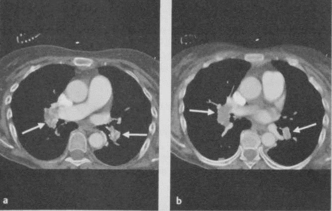Снимки МРТ и КТ. Острая легочная гипертензия, тромбоэмболия легочны