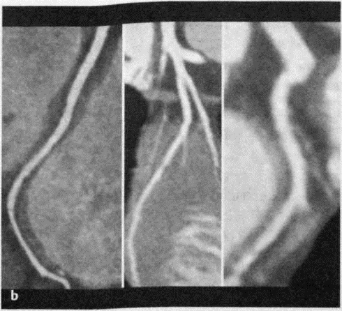 Снимки МРТ и КТ. Ишемическая болезнь сердца
