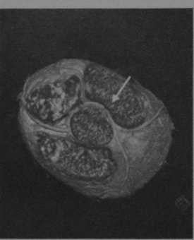 Снимки МРТ и КТ. Пороки развития коронарных артерий