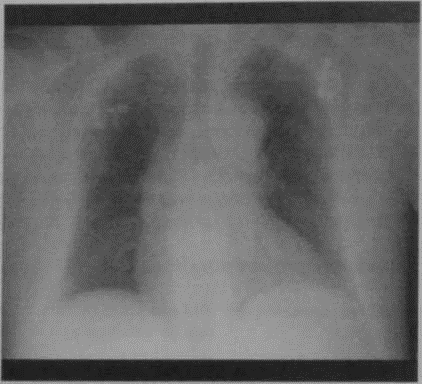 Снимки МРТ и КТ. Постинфарктный кардиосклероз