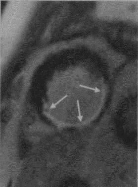 Снимки МРТ и КТ. Постинфарктный кардиосклероз