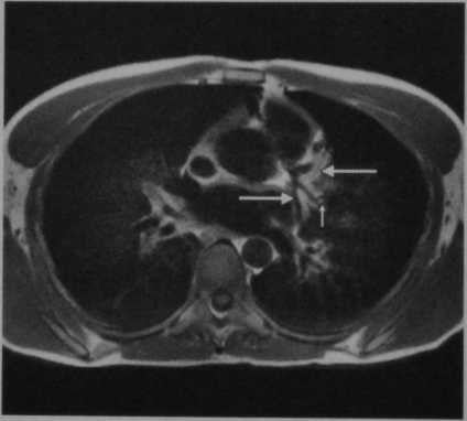 Снимки МРТ и КТ. Синдром Бланда-Уайта-Гарланда