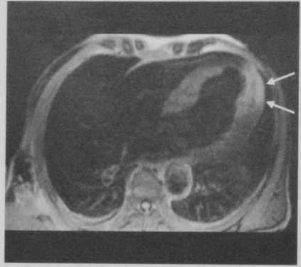 Снимки МРТ и КТ. Инфаркт миокарда